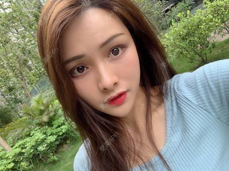 更美 - 假装很正经的自体脂肪丰苹果肌经验 | 自体脂肪填充泪沟 | 视频日记 | 自体脂肪丰苹果肌 | 广州