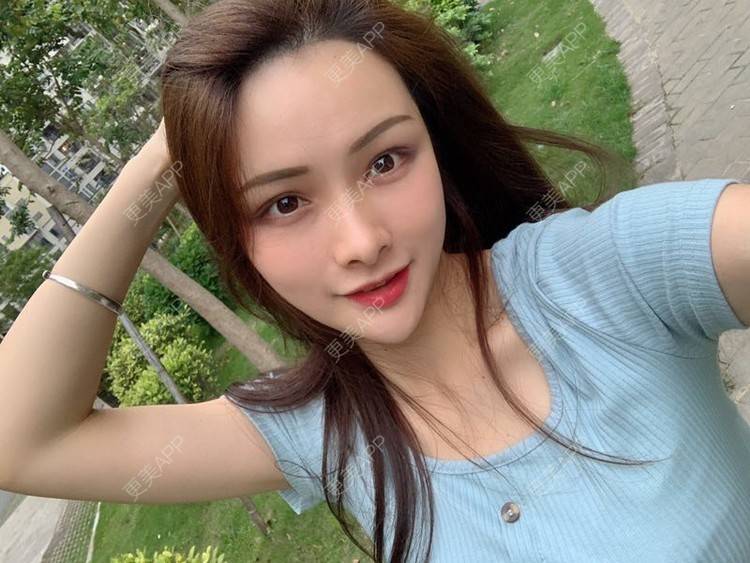 更美 - 假装很正经的自体脂肪丰苹果肌经验 | 自体脂肪填充泪沟 | 视频日记 | 自体脂肪丰苹果肌 | 广州