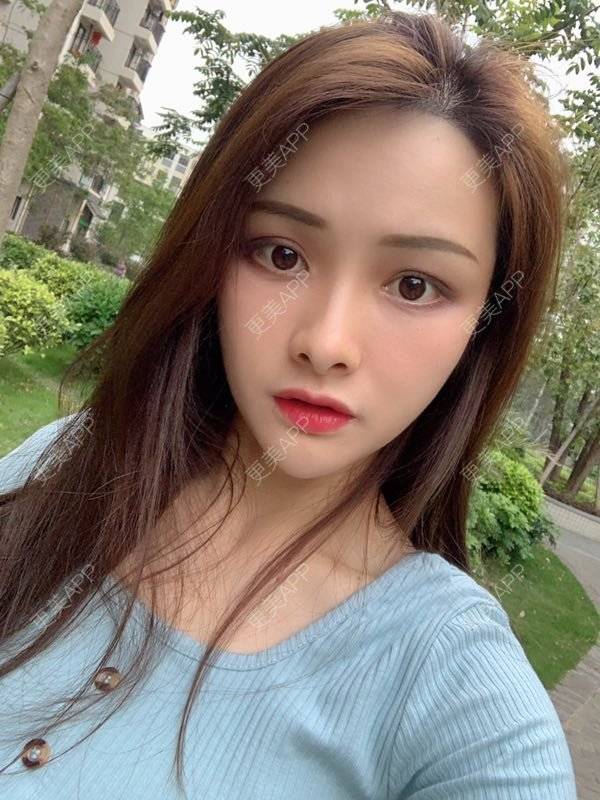 更美 - 假装很正经的自体脂肪丰苹果肌经验 | 自体脂肪填充泪沟 | 视频日记 | 自体脂肪丰苹果肌 | 广州