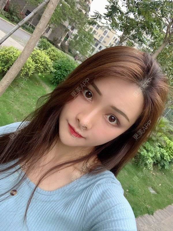 更美 - 假装很正经的自体脂肪丰苹果肌经验 | 自体脂肪填充泪沟 | 视频日记 | 自体脂肪丰苹果肌 | 广州