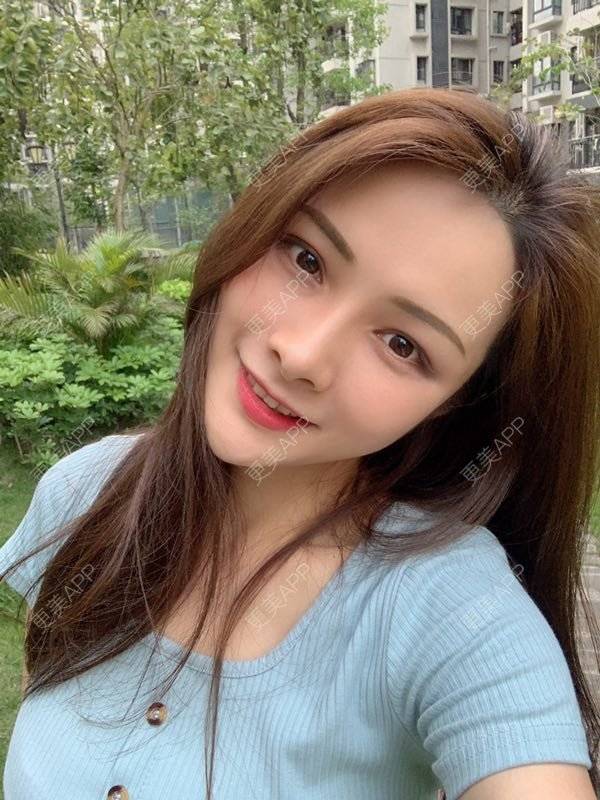 更美 - 假装很正经的自体脂肪丰苹果肌经验 | 自体脂肪填充泪沟 | 视频日记 | 自体脂肪丰苹果肌 | 广州