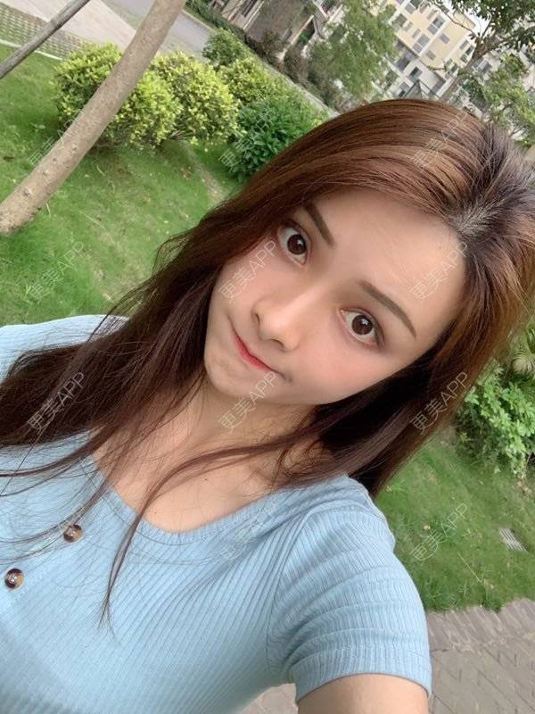 更美 - 假装很正经的自体脂肪丰苹果肌经验 | 自体脂肪填充泪沟 | 视频日记 | 自体脂肪丰苹果肌 | 广州