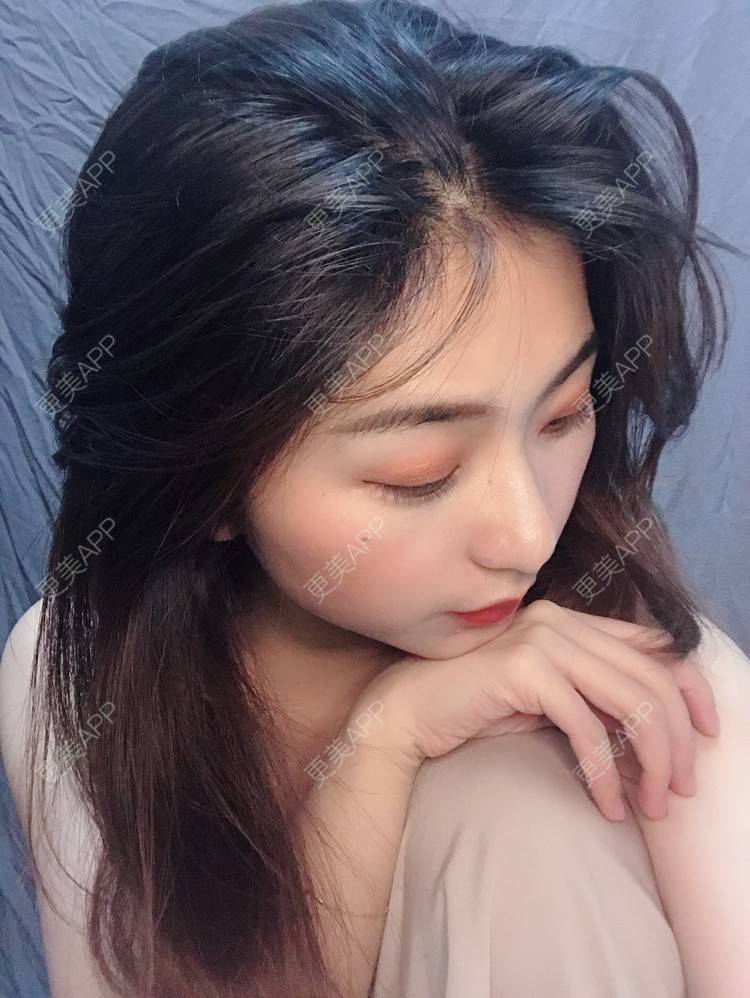 更美 - 更美用户h6811W70iO的鼻翼缩小经验 | 鼻翼缩小 | 福州 | 人工骨隆鼻 | 真皮隆鼻 | 长鼻矫正 | 微晶瓷隆鼻