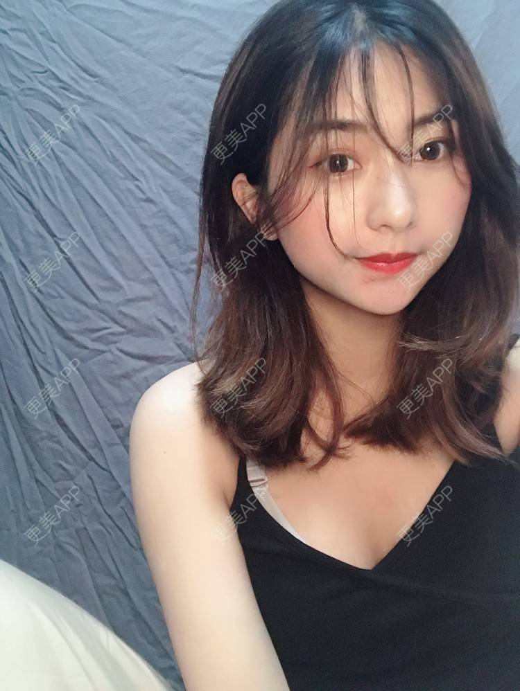 更美 - 更美用户h6811W70iO的鼻翼缩小经验 | 鼻翼缩小 | 福州 | 人工骨隆鼻 | 真皮隆鼻 | 长鼻矫正 | 微晶瓷隆鼻
