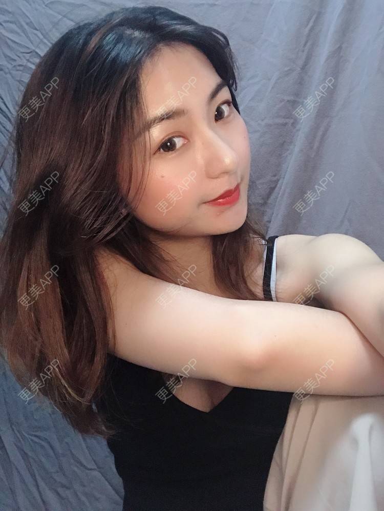 更美 - 更美用户h6811W70iO的鼻翼缩小经验 | 鼻翼缩小 | 福州 | 人工骨隆鼻 | 真皮隆鼻 | 长鼻矫正 | 微晶瓷隆鼻