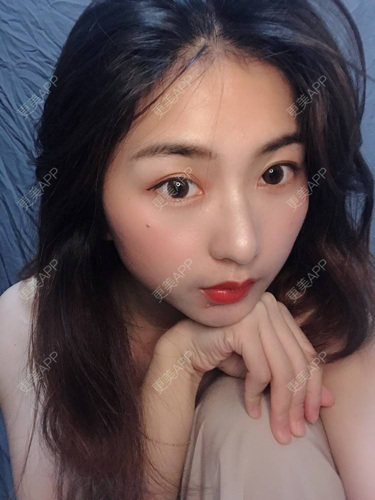 更美 - 更美用户h6811W70iO的鼻翼缩小经验 | 鼻翼缩小 | 福州 | 人工骨隆鼻 | 真皮隆鼻 | 长鼻矫正 | 微晶瓷隆鼻