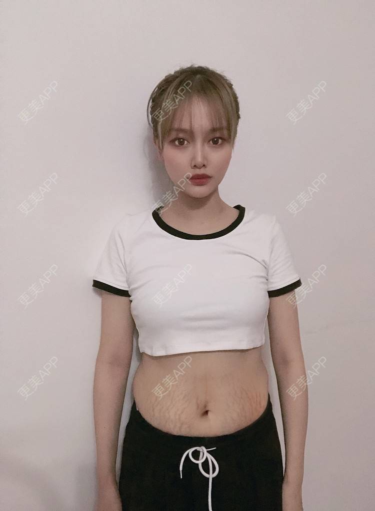 更美 - 息了三秋趟的经验 | 成都 | 激光淡化妊娠纹
