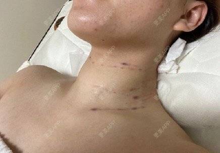 更美 - 川水往事咏的玻尿酸颈纹经验 | 玻尿酸颈纹 | 上海