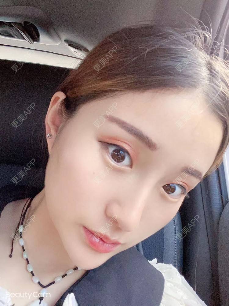 更美 - 小明你好我要美美1的鼻部多项经验 | 鼻部多项 | 广州 | 耳软骨隆鼻