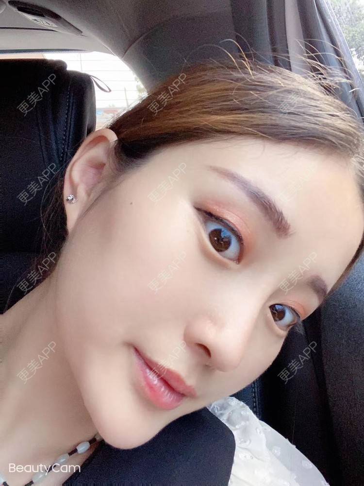更美 - 小明你好我要美美1的鼻部多项经验 | 鼻部多项 | 广州 | 耳软骨隆鼻