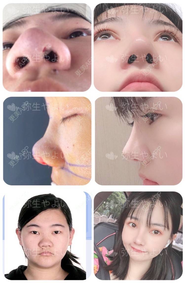 更美 - 弥生 丶的自体软骨垫鼻尖经验 | 硅胶隆鼻 | 鼻翼缩小 | 鼻部硅胶假体取出 | 鼻小柱延长 | 自体软骨垫鼻尖 | 上海