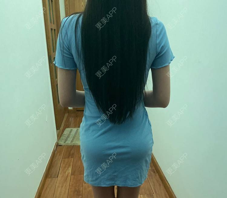 更美 - 更美用户OYzpM6ubGO的假体丰臀经验 | 深圳 | 假体丰臀