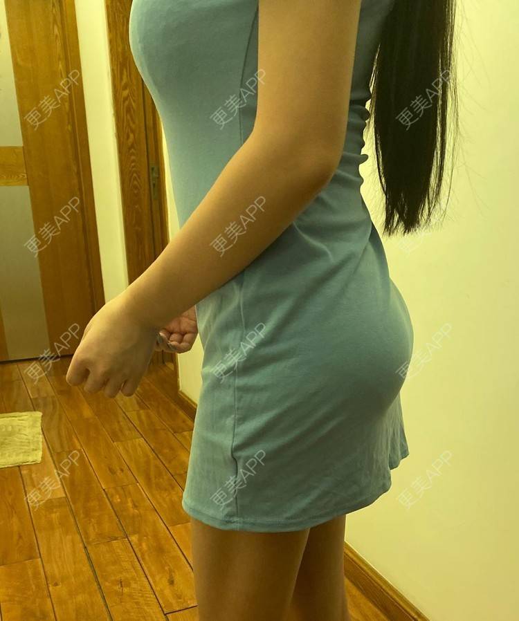 更美 - 更美用户OYzpM6ubGO的假体丰臀经验 | 深圳 | 假体丰臀