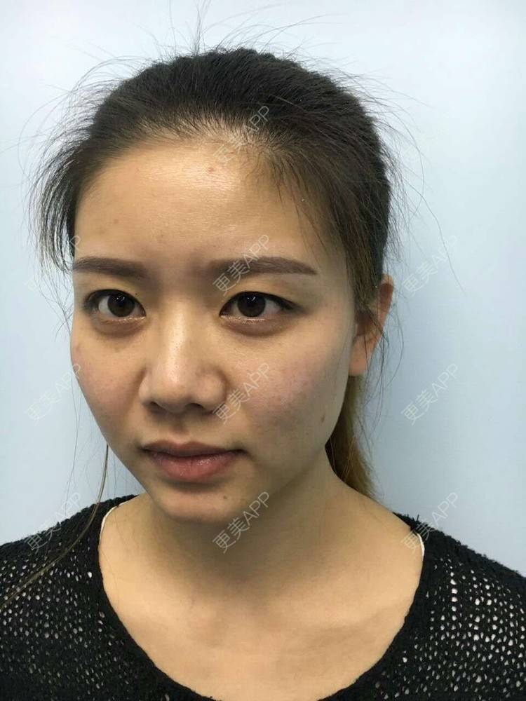 更美 - 阿小宝的全切双眼皮经验 | 成都 | 开内眼角 | 开外眼角 | 定点双眼皮