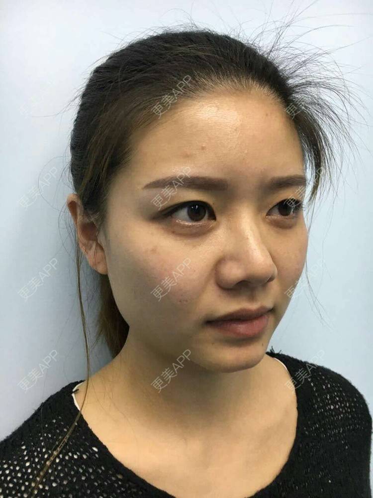更美 - 阿小宝的全切双眼皮经验 | 成都 | 开内眼角 | 开外眼角 | 定点双眼皮