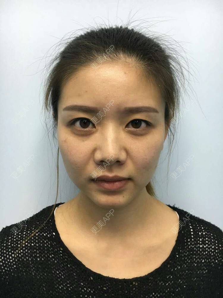 更美 - 阿小宝的全切双眼皮经验 | 成都 | 开内眼角 | 开外眼角 | 定点双眼皮