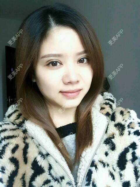 更美 - 阿小宝的全切双眼皮经验 | 全切双眼皮 | 定点双眼皮 | 开内眼角 | 开外眼角 | 成都