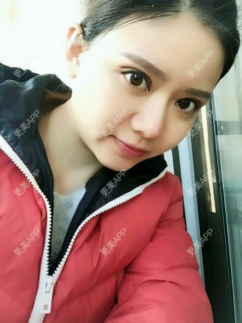 更美 - 阿小宝的全切双眼皮经验 | 全切双眼皮 | 定点双眼皮 | 开内眼角 | 开外眼角 | 成都