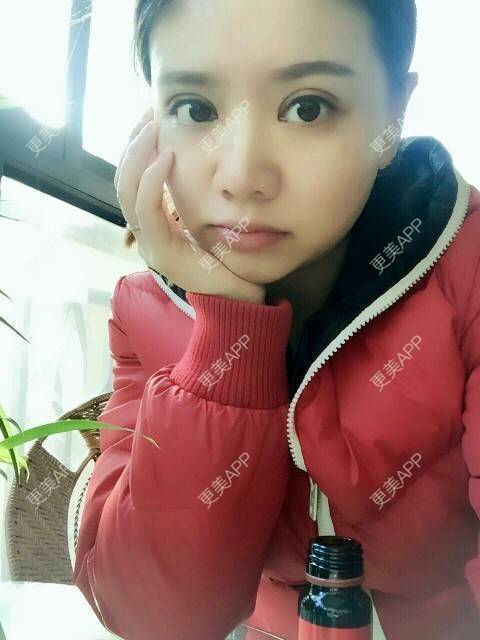 更美 - 阿小宝的全切双眼皮经验 | 全切双眼皮 | 定点双眼皮 | 开内眼角 | 开外眼角 | 成都