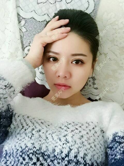 更美 - 阿小宝的全切双眼皮经验 | 全切双眼皮 | 定点双眼皮 | 开内眼角 | 开外眼角 | 成都