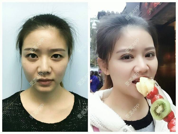 更美 - 阿小宝的全切双眼皮经验 | 全切双眼皮 | 定点双眼皮 | 开内眼角 | 开外眼角 | 成都