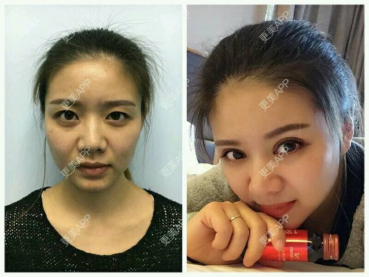 更美 - 阿小宝的全切双眼皮经验 | 全切双眼皮 | 定点双眼皮 | 开内眼角 | 开外眼角 | 成都