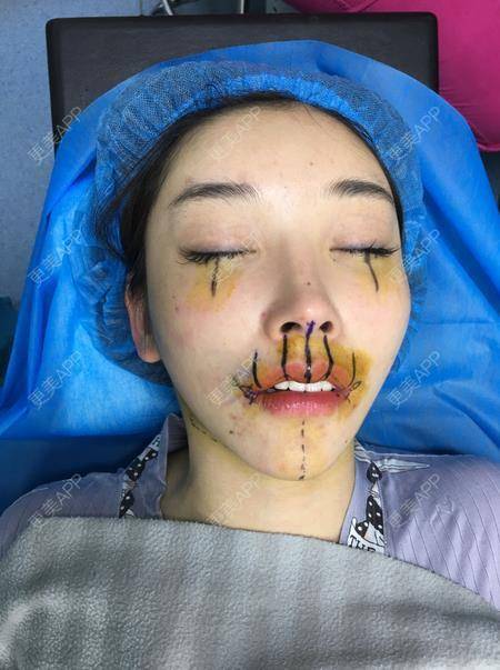 更美用户1f58myz9z6的m唇成形术日记