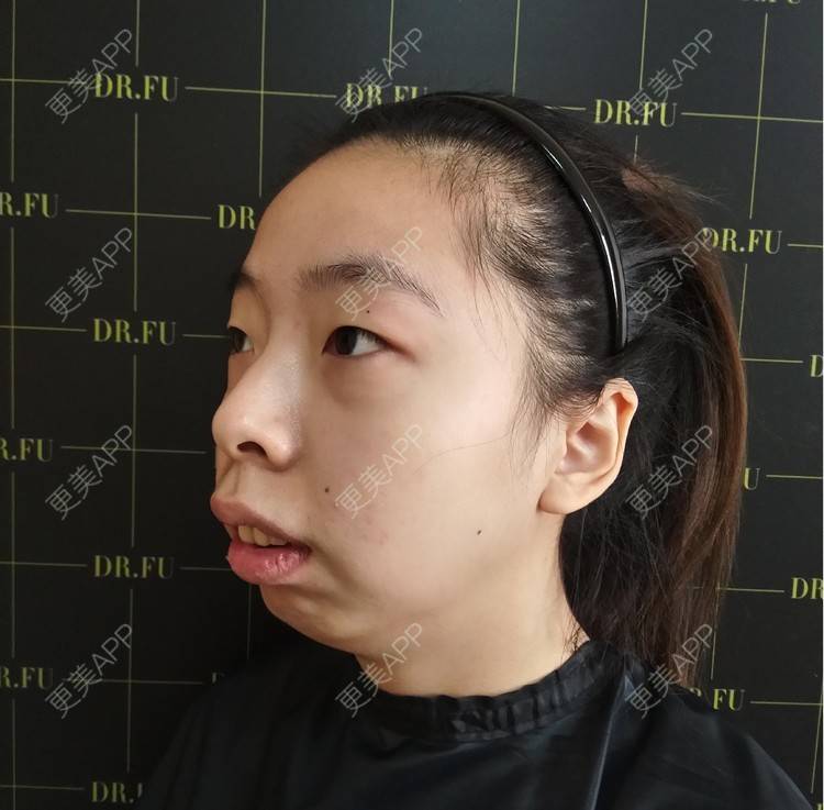 更美用户tead6dlazq的凸嘴矫正日记