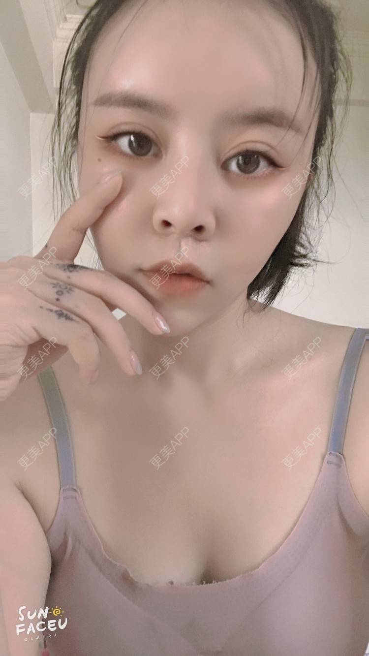 更美 - 更美用户iuB00h31N3的鼻部多项经验 | 视频日记 | 鼻部多项 | 肋软骨隆鼻 | 广州