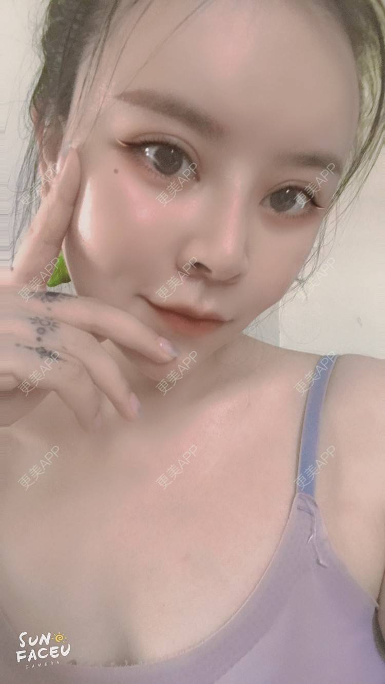 更美 - 更美用户iuB00h31N3的鼻部多项经验 | 视频日记 | 鼻部多项 | 肋软骨隆鼻 | 广州