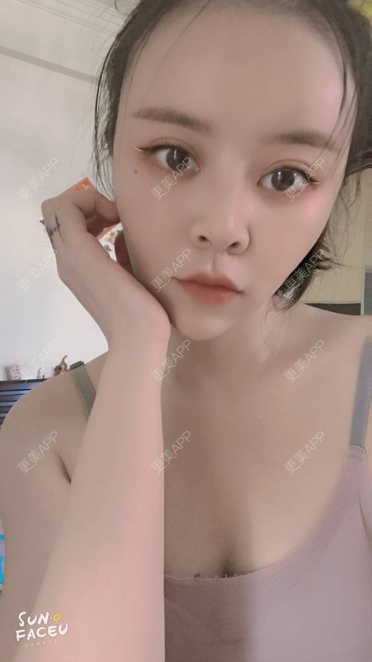 更美 - 更美用户iuB00h31N3的鼻部多项经验 | 视频日记 | 鼻部多项 | 肋软骨隆鼻 | 广州