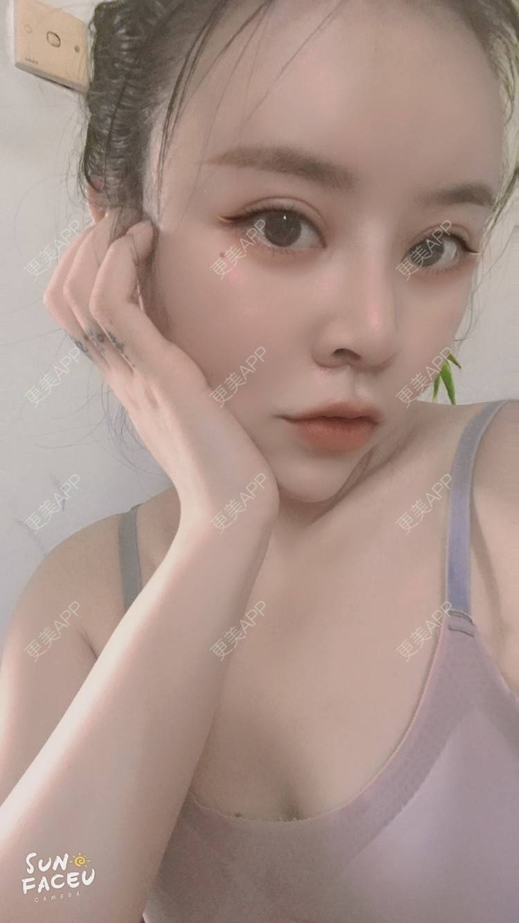 更美 - 更美用户iuB00h31N3的鼻部多项经验 | 视频日记 | 鼻部多项 | 肋软骨隆鼻 | 广州