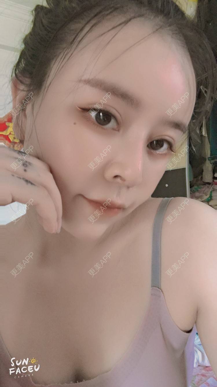 更美 - 更美用户iuB00h31N3的鼻部多项经验 | 视频日记 | 鼻部多项 | 肋软骨隆鼻 | 广州