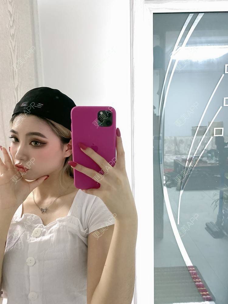 更美 - 欧美挂的全切双眼皮经验 | 全切双眼皮 | 南京