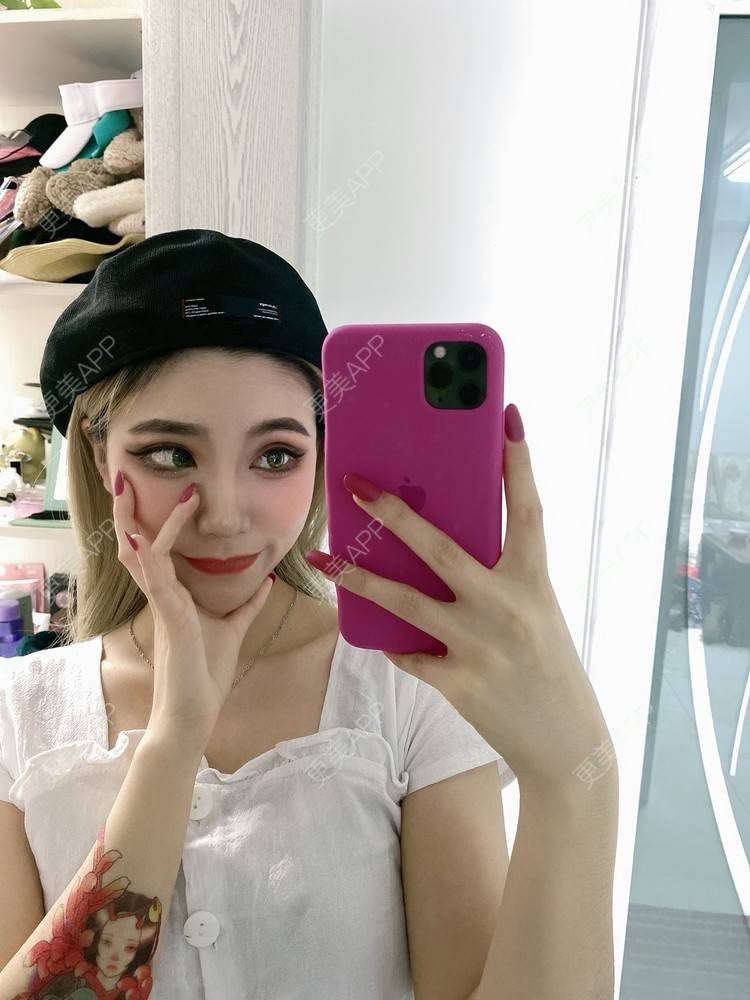 更美 - 欧美挂的全切双眼皮经验 | 全切双眼皮 | 南京