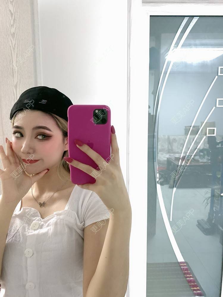 更美 - 欧美挂的全切双眼皮经验 | 全切双眼皮 | 南京