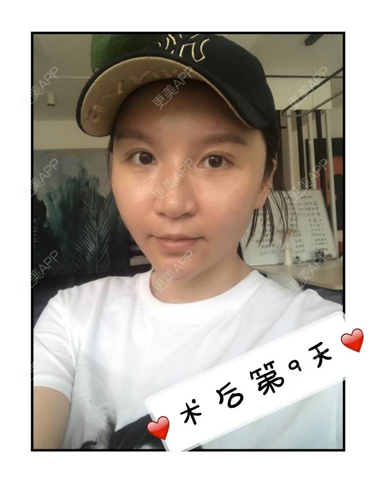 更美 - 更美用户GFaNHWYxeJ的自体脂肪丰苹果肌经验 | 自体脂肪全面部填充 | 自体脂肪填充面部细纹 | 自体脂肪丰苹果肌 | 自体脂肪丰面颊 | 自体脂肪丰额头