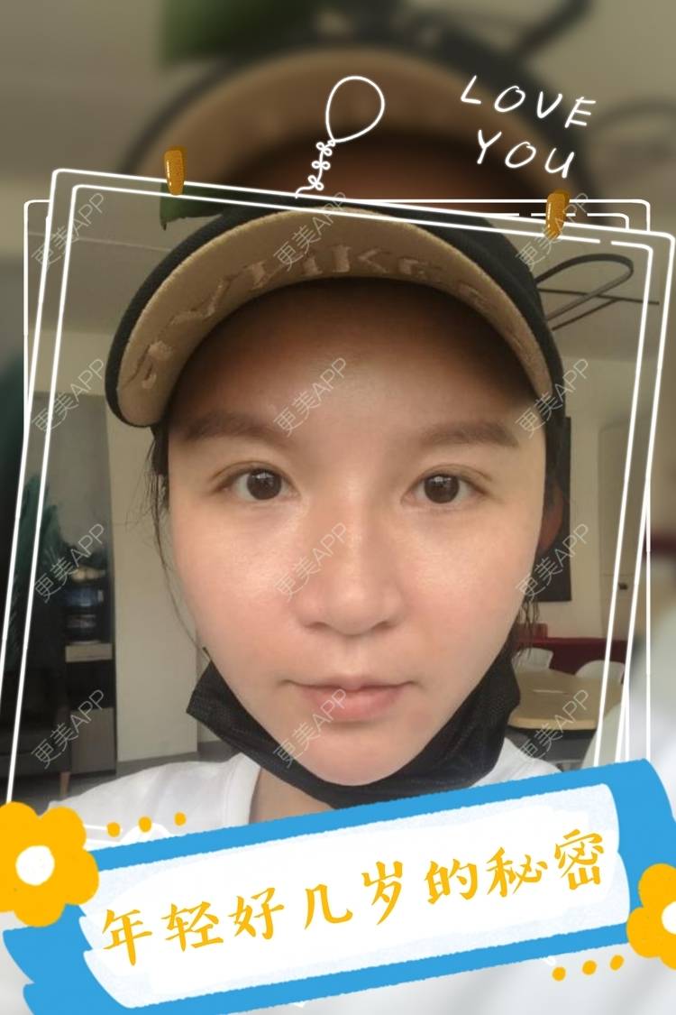 更美 - 更美用户GFaNHWYxeJ的自体脂肪丰苹果肌经验 | 自体脂肪全面部填充 | 自体脂肪填充面部细纹 | 自体脂肪丰苹果肌 | 自体脂肪丰面颊 | 自体脂肪丰额头