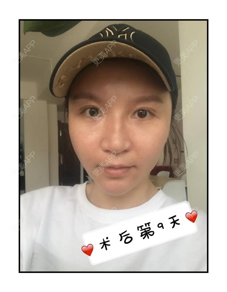 更美 - 更美用户GFaNHWYxeJ的自体脂肪丰苹果肌经验 | 自体脂肪全面部填充 | 自体脂肪填充面部细纹 | 自体脂肪丰苹果肌 | 自体脂肪丰面颊 | 自体脂肪丰额头