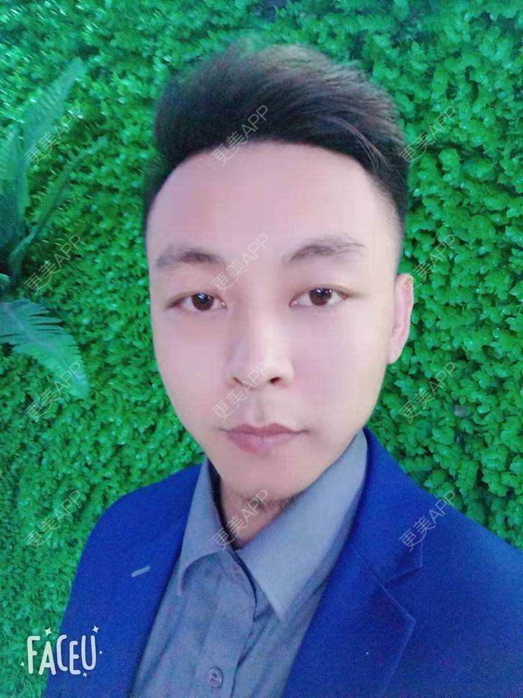 更美 - 今天敲代码了吗的植发际线经验 | 广州 | 视频日记 | 植发际线