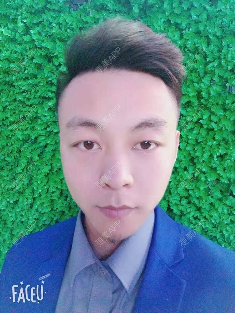 更美 - 今天敲代码了吗的植发际线经验 | 广州 | 视频日记 | 植发际线