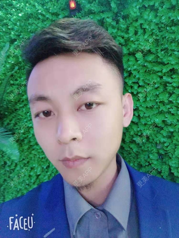 更美 - 今天敲代码了吗的植发际线经验 | 广州 | 视频日记 | 植发际线