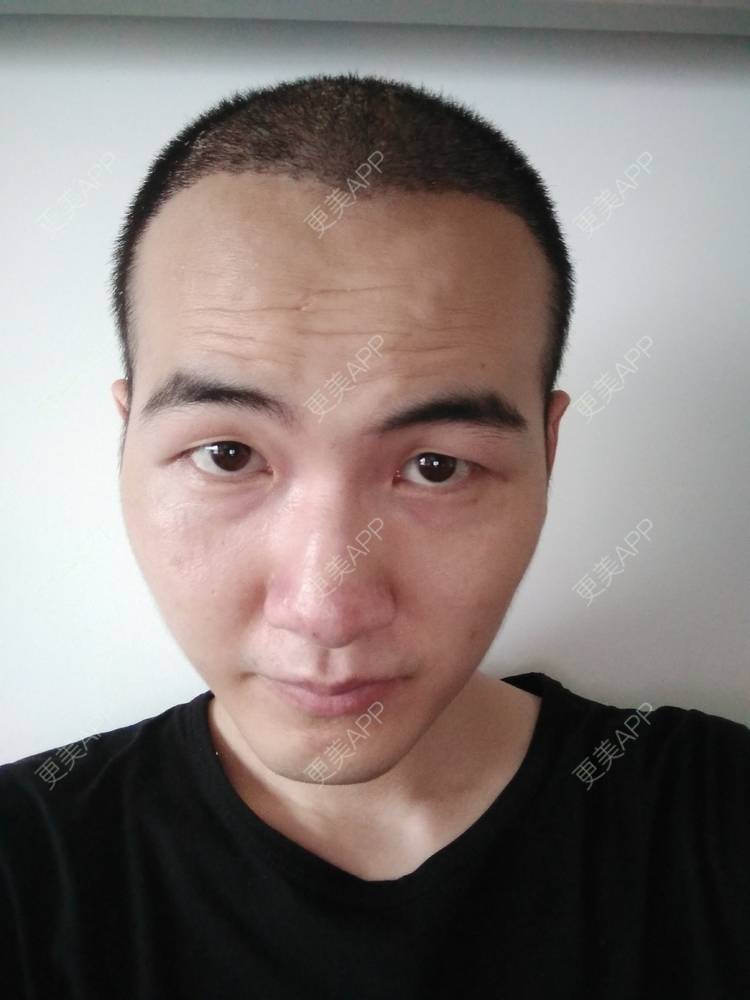 更美 - 更美用户wHSFRCieMm的植胡须经验 | 武汉 | 植胡须