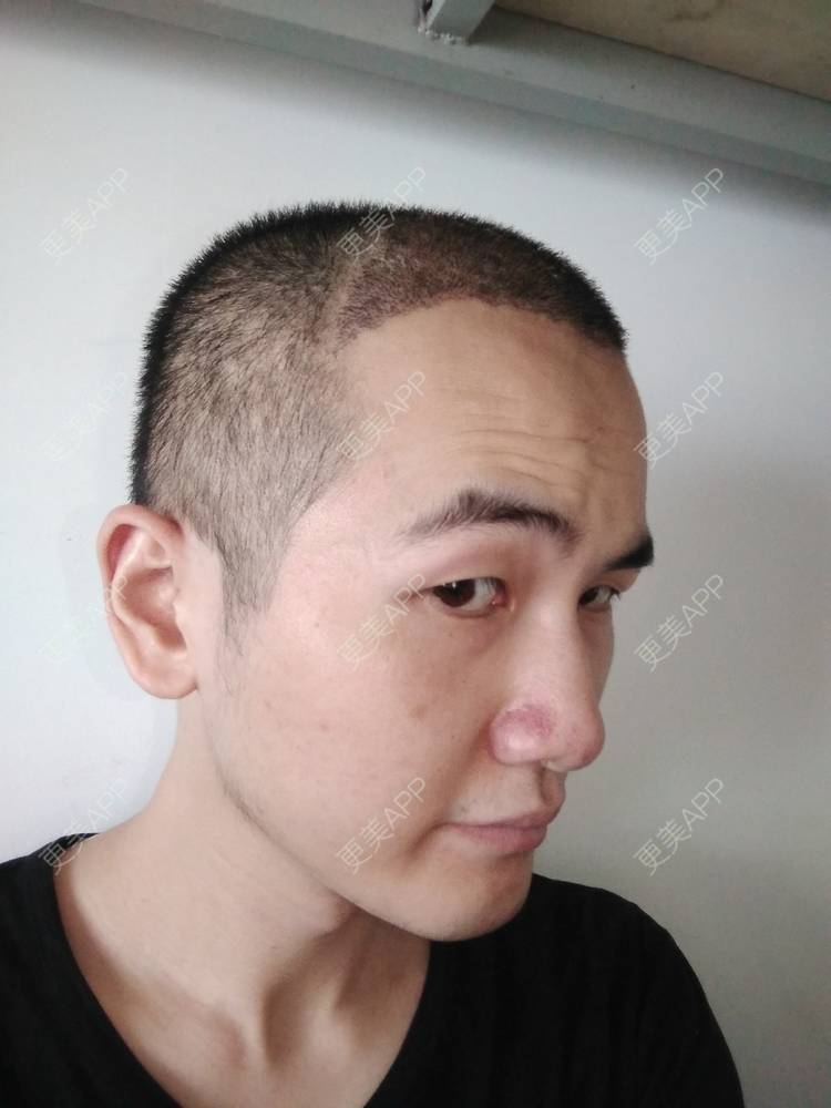 更美 - 更美用户wHSFRCieMm的植胡须经验 | 武汉 | 植胡须