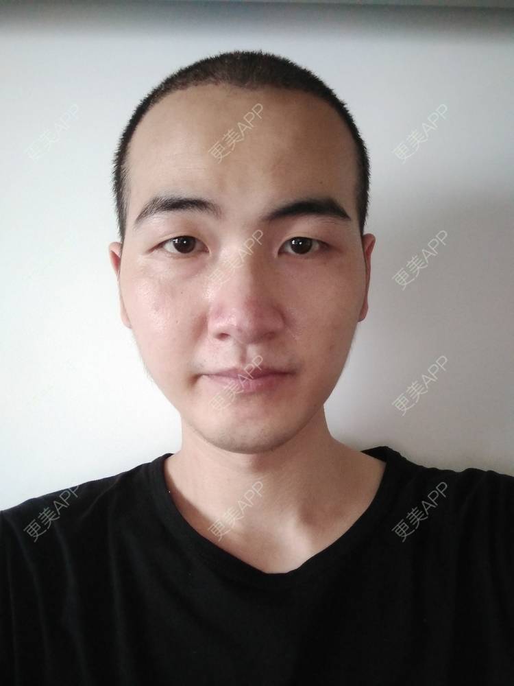 更美 - 更美用户wHSFRCieMm的植胡须经验 | 武汉 | 植胡须