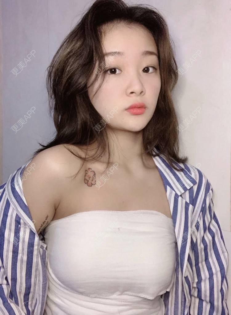 更美 - 更美用户kCkKIYluPU的假体隆胸经验 | 假体隆胸 | 南昌