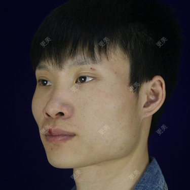 李继华【下颌角切除术】长曲线下颌角截骨 下颌角整形 截骨磨骨削骨