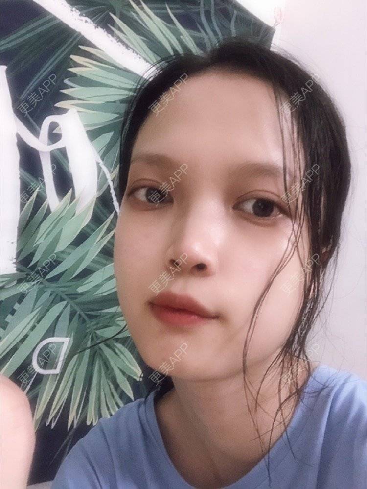 更美 - 更美用户NpS93HK67Y的双眼皮经验 | 双眼皮 | 广州
