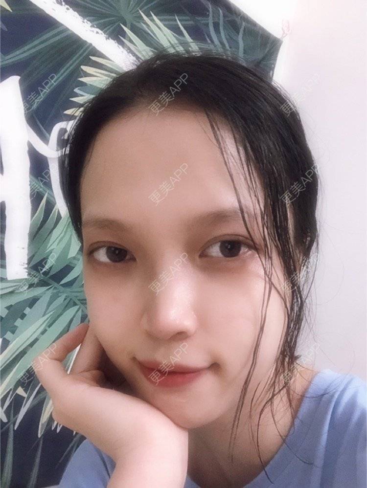 更美 - 更美用户NpS93HK67Y的双眼皮经验 | 双眼皮 | 广州