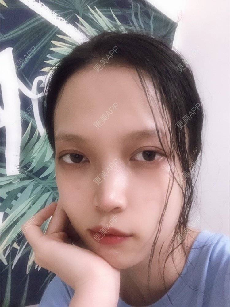 更美 - 更美用户NpS93HK67Y的双眼皮经验 | 双眼皮 | 广州